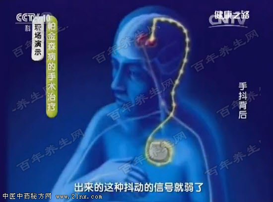 手术治疗帕金森