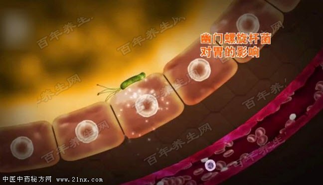 幽门螺旋杆菌对胃的影响