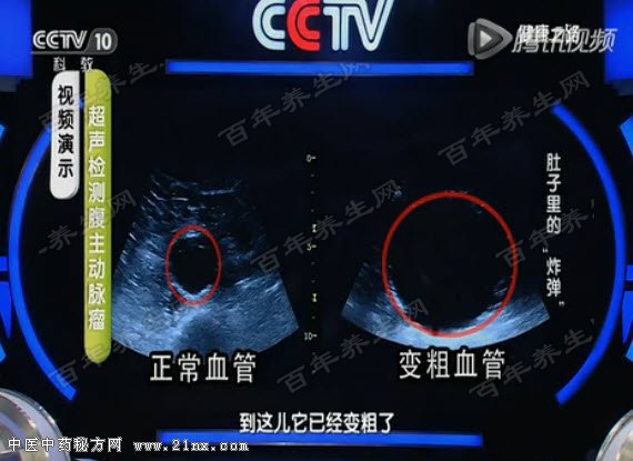 超声检查腹主动脉瘤