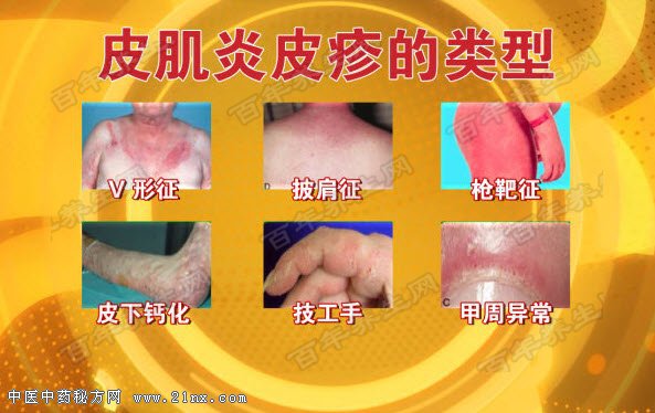 养生堂视频和笔记20160519 王国春介绍皮疹要警惕