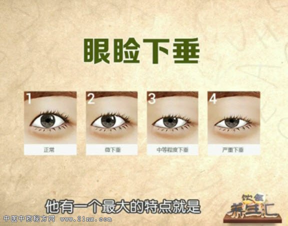 重症肌无力的表现