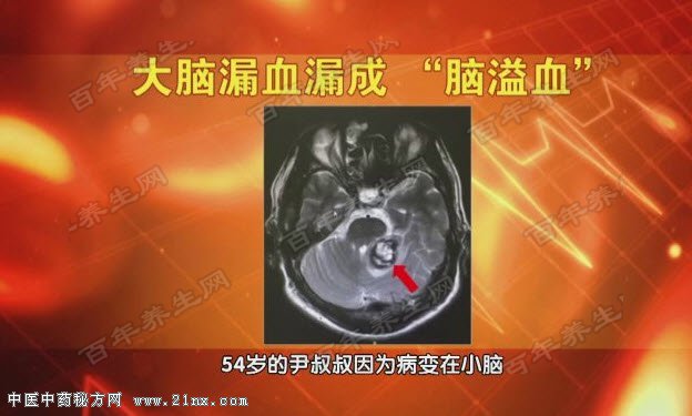 大脑漏血