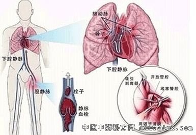 刘鹏如何预防血栓肺栓塞