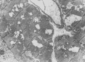 线粒体肿胀(基质型)空泡变(心肌缺氧)