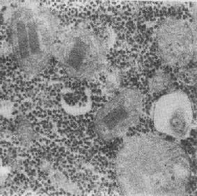 线粒体内晶形包含体(进行性肌营养不良症)