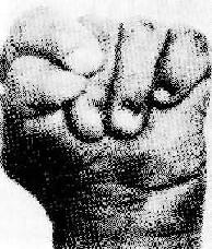 (Edwards)综合征的肌张力增高