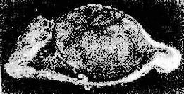 良性肿瘤的膨胀性生长(肾上腺皮质腺瘤)