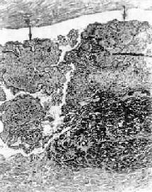 管腔内血栓的放大,主要为白色血栓(↑);右下为纤维素