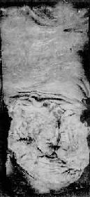 直肠癌(隆起息肉型)