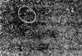 弥漫性硬化性肾小球肾炎