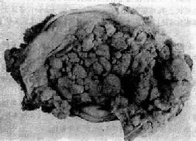 子宫体腺癌(弥漫型)