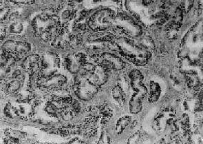 前列腺癌(高分化型)