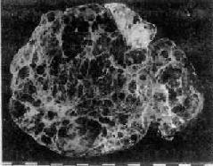 结节性地方性甲状腺肿 (大体切面)