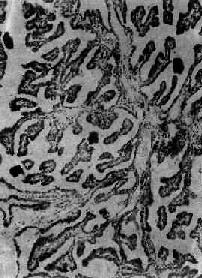 甲状腺乳头状腺癌