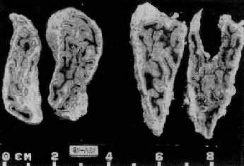 肾上腺皮质弥漫增生(大体)