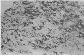 反应性星形胶质细胞增生(GFAP染色)