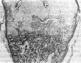 佝偻病的骨软骨交界处(肋骨)