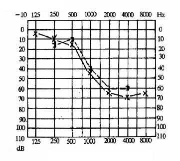 感音神经性聋(左耳)