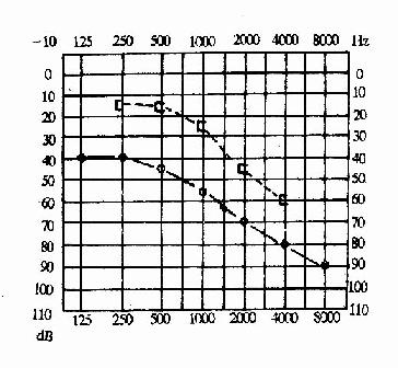 混合性耳聋(右耳)