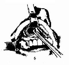 上颌窦根治术 6.扩大前壁洞口,清理病变组织