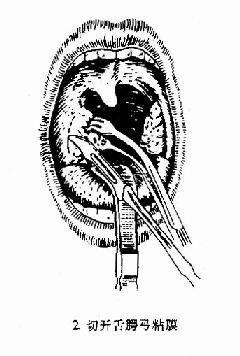扁桃体切除术(剥离法)