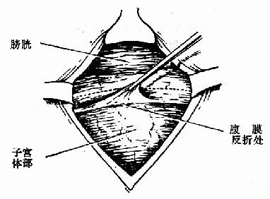 提起反折腹膜,沿虚线切开