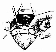 切开腹膜向上游离至反折处,便于最后缝合