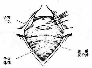 先作一小切口,刺破胎膜