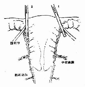 1.应斜向钳夹,以阴断全部上行血流2.垂直夹,可将部分血管遗漏