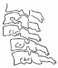 颈5~6脱位,小关节跳跃