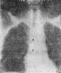 气道肿瘤(两箭头之间)