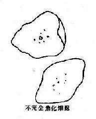 复层扁平(鳞状)上皮各层脱落细胞示意图