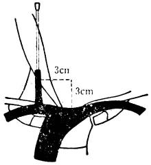 经前路入么穿刺颈内静脉