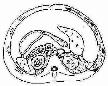 出血经腹膜后间隙到达皮下脂肪,引起一侧或双侧胁腹部瘀斑和变色(Grey Turner征)