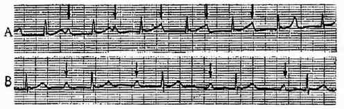 第一度房室传导阻滞