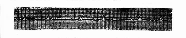 Ⅱ度Ⅰ型房室传导阻滞(文氏现象)