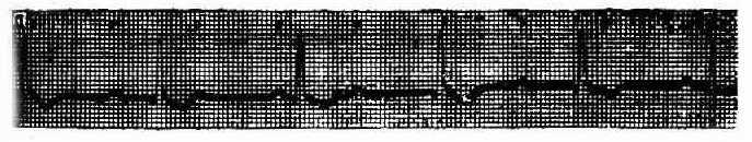 第三度房室传导阻滞(心室起搏点在房室束分叉以上)