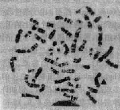 PhȾɫʾ 922λ9q34;22q11;fi 22q-;ʾ9+(̾ṩ)