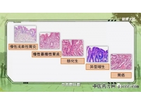 健康之路20180822:宋志强,胃炎到胃癌,幽门螺杆菌检测