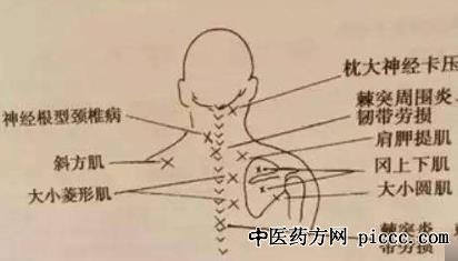 健康之路20200313:孙宇庆,神经根型颈椎病的治疗方法