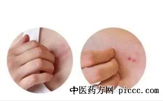 湿疹与变态反应 湿疹火针疗法 穴位注射疗法