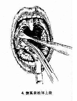 第六节 慢性扁桃体炎(chronic tonsillitis)