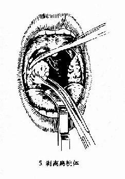 第六节 慢性扁桃体炎(chronic tonsillitis)