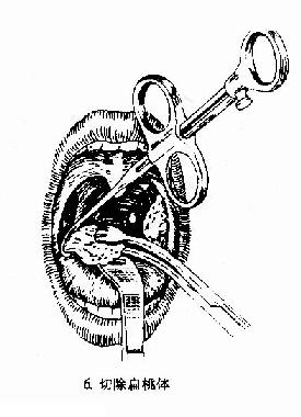第六节 慢性扁桃体炎(chronic tonsillitis)