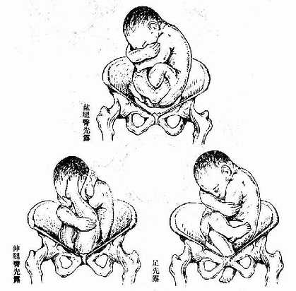> 第四章 正常妊娠图24 臀位,均为骶左后 (3)胎方位 胎儿先露部的指示