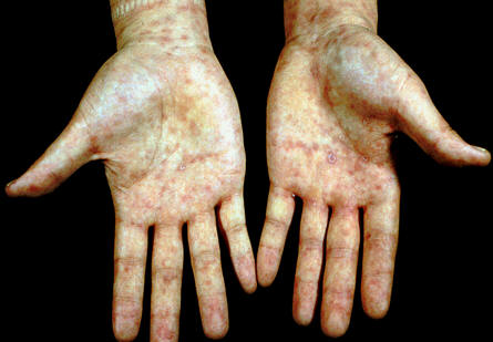 二期梅毒疹(手掌)