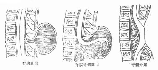 第二节 脊柱裂