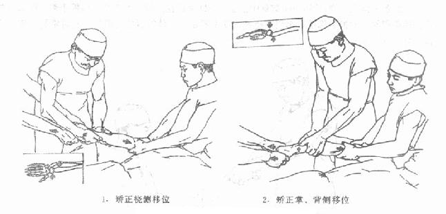 图3-45 桡骨下端伸直型骨折复位情况