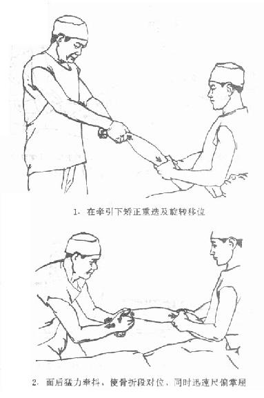 第八节 桡骨远端骨折
